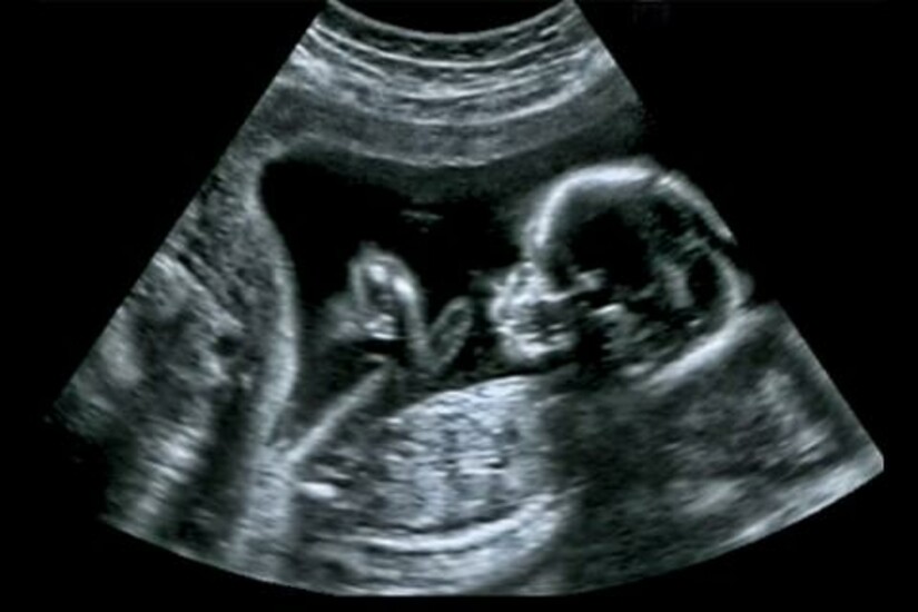 Ultrasound image of a fetus