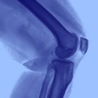 Synovial Sarcoma