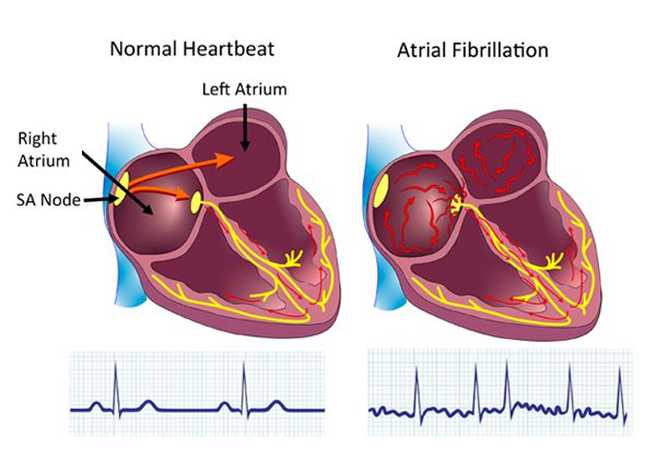 Atrial Fibrillation (AFib) Background