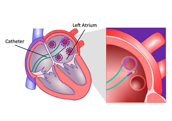 Ablation: One Current Solution for Atrial Fibrillation (AFib)