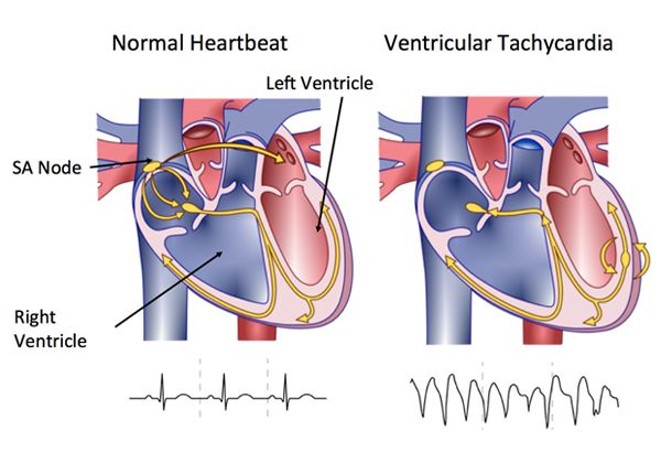 Ventricular Tachycardia (VT)