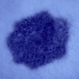 Melanoma