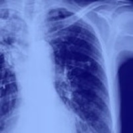 Non-Small Cell Lung Cancer (NSCLC)