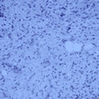 Myxoid/Round Cell Liposarcoma (MRCLS)