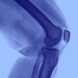 Synovial Sarcoma