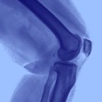 Synovial Sarcoma