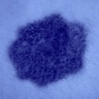 Melanoma