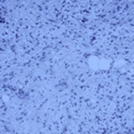 Myxoid/Round Cell Liposarcoma (MRCLS)