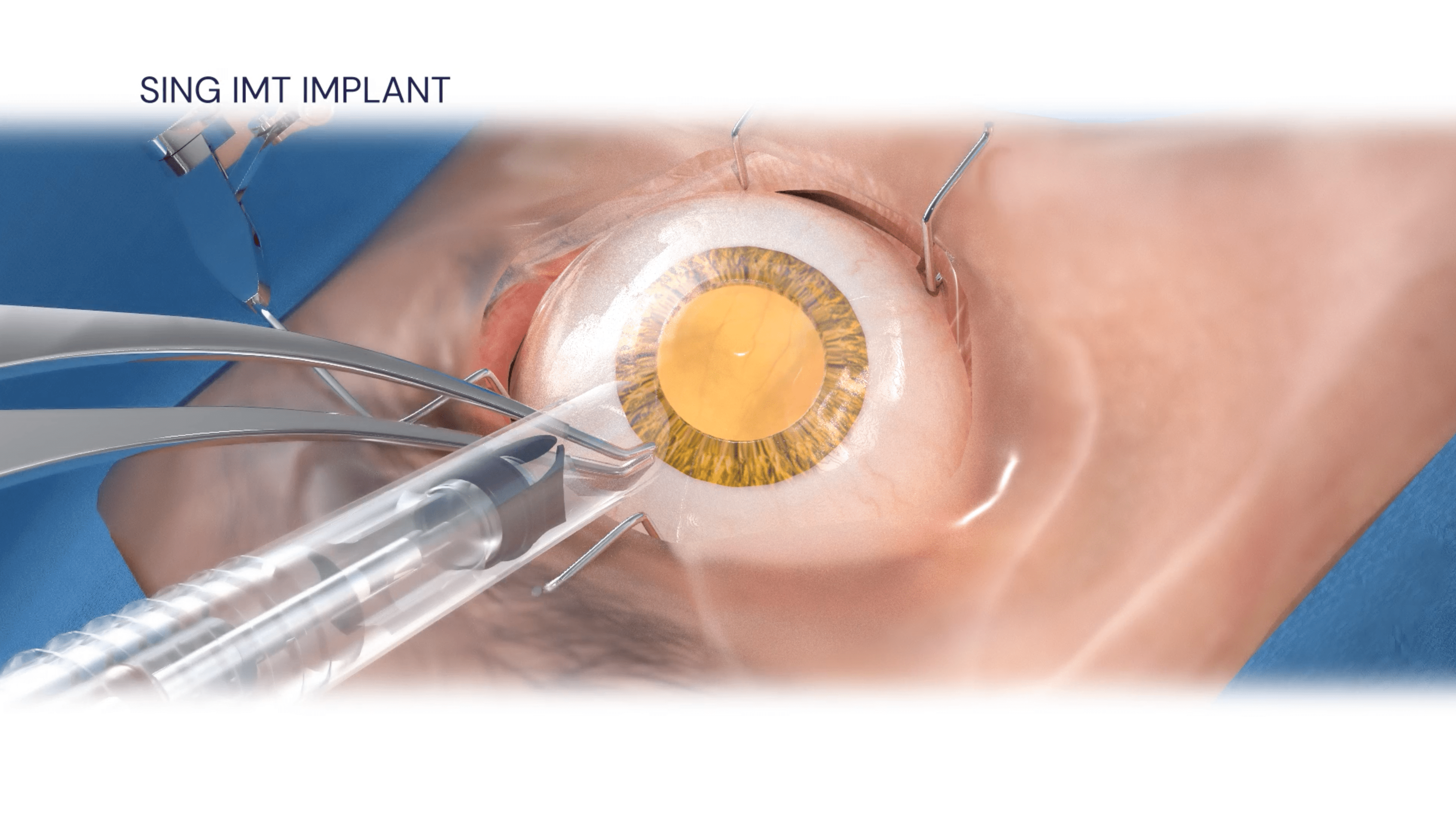 About the SING IMT Technology