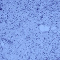 Myxoid/Round Cell Liposarcoma (MRCLS)