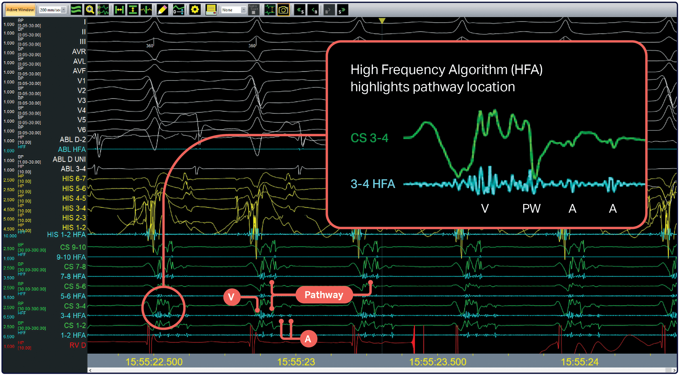 Graphic showing Cardiac data; highlights CS 3-4 and 3-4 HFA comparison